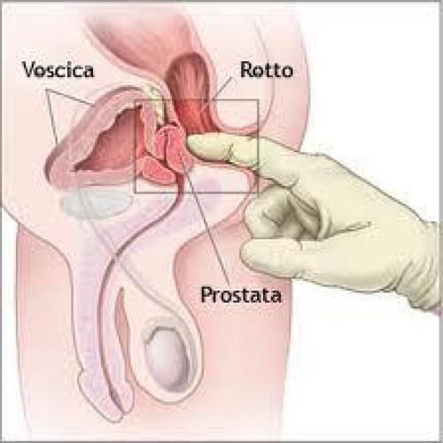erezione e prostata